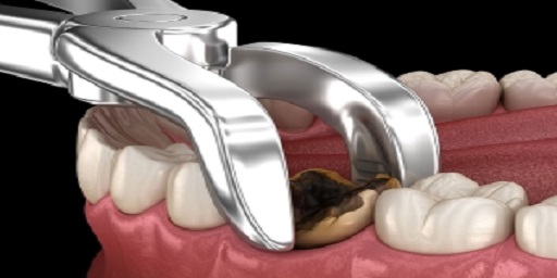 جراحی و كشيدن دندان عقل - دندان آسیا