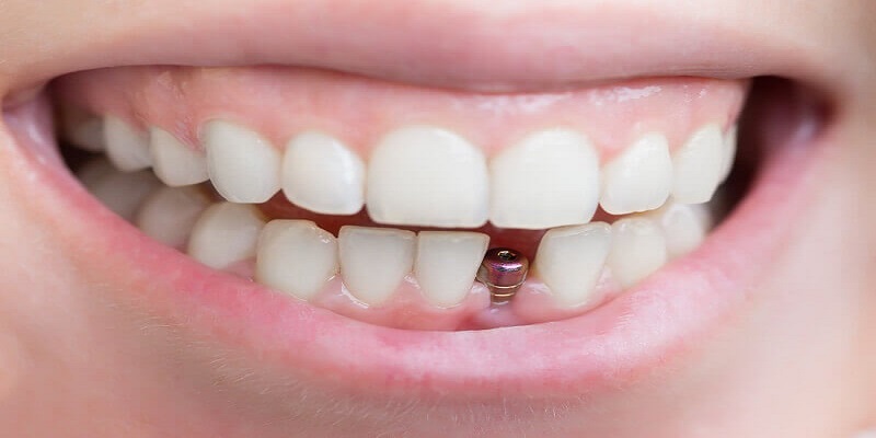 ایمپلنت دندان - کاشت دندان چقدر هزینه دارد