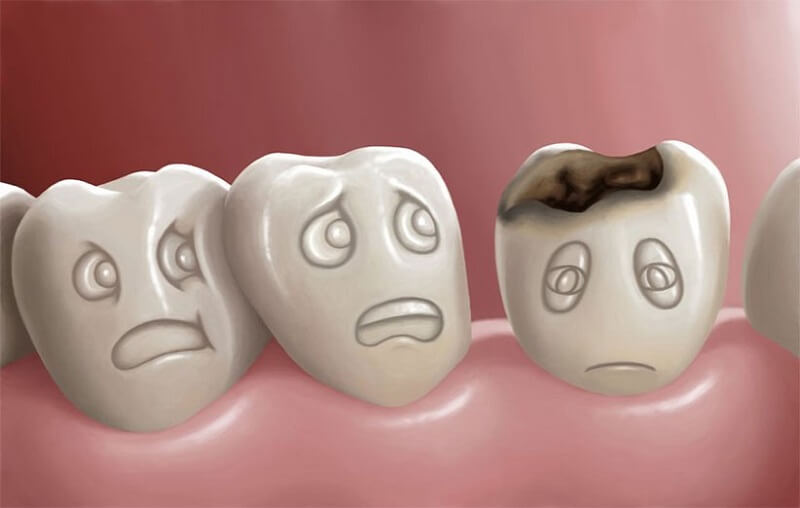 درمان پوسیدگی دندان چگونه است؟