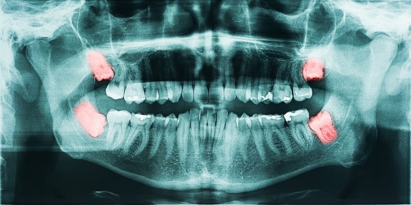دلایل جراحی و کشیدن دندان عقل