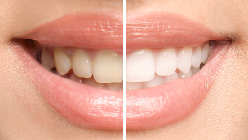 بليچينگ دندان Tooth-scaling-and-bleaching