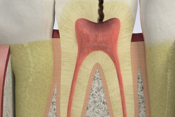 عصب کشی دندان چگونه است