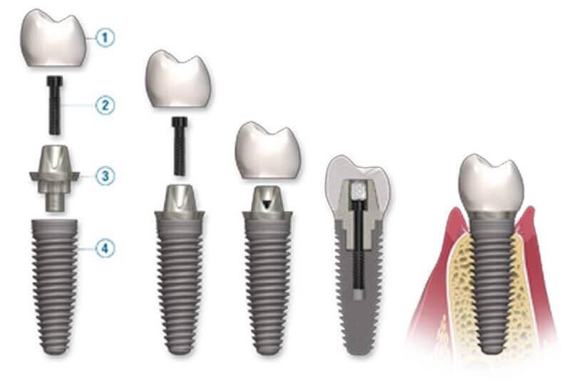 دندان های مصنوعی  implant