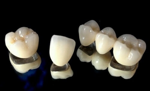 پروتز ثابت دندان - روکش دندان