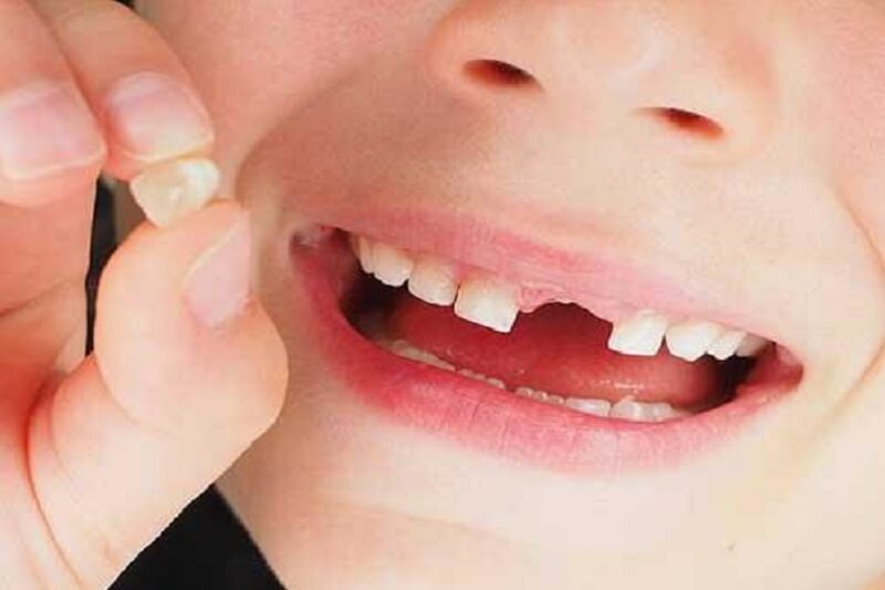 خراب شدن دندان شیری کودکان
