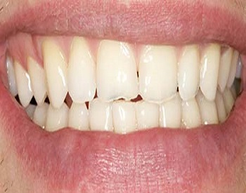 علت دندان قروچه